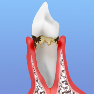 中期の歯周炎